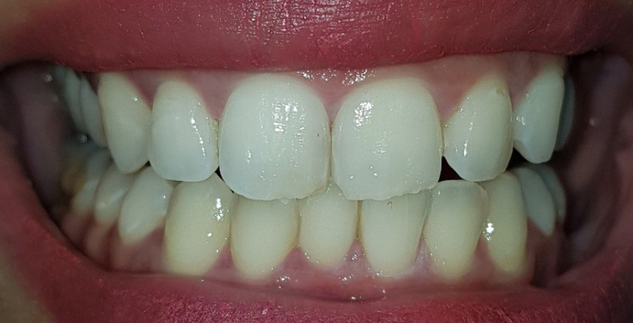 بعد تبيض-ليزر 5